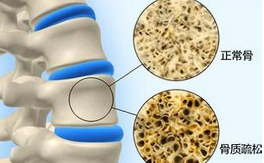 骨質(zhì)疏松，不僅補(bǔ)鈣這么簡單！